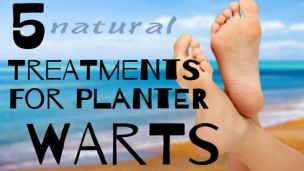 How and Why to Treat Plantar Warts Naturally (5 Ways)