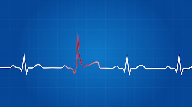 Blueprint Of Heart Attack On Electrocardiogram