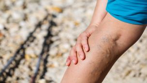 How to Prevent and Reverse Spider Veins and Varicose Veins
