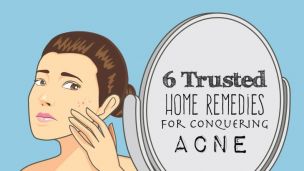 6 Trusted Home Remedies For Conquering Acne