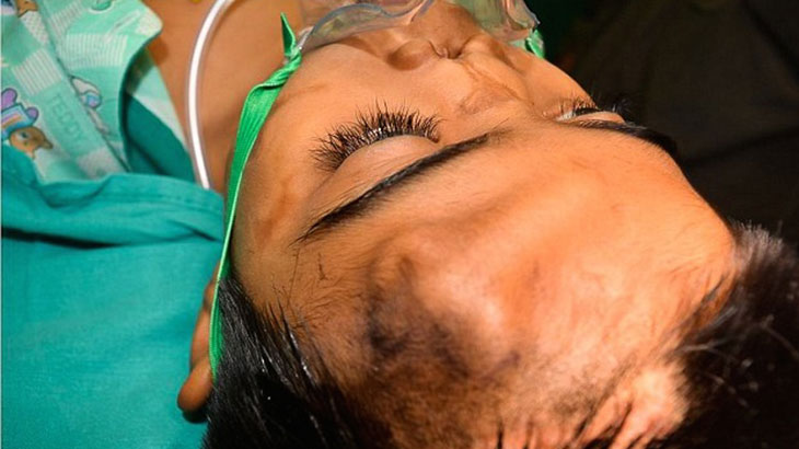 Doctors Grow New Nose On Boy’s Forehead