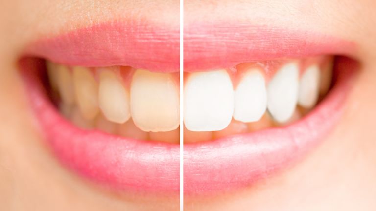 7 Strange Yet Effective Ways to Whiten Your Teeth