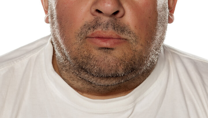 Hate Your Double Chin? Try These 7 Easy Home Remedies