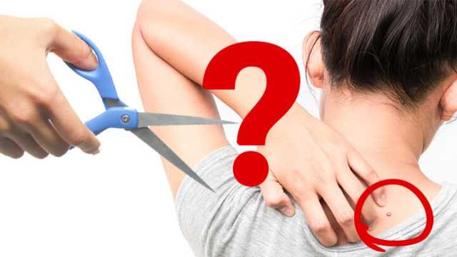 Should I cut my skin tags off