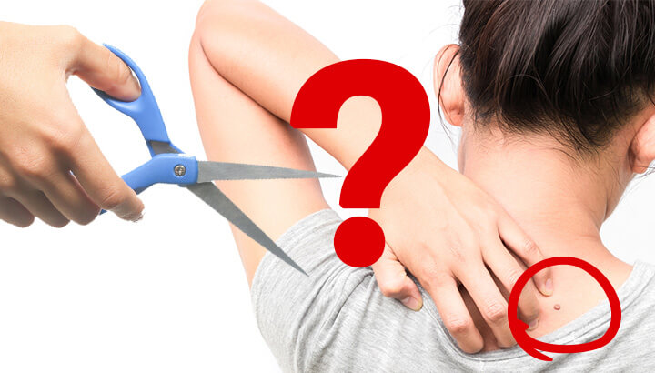 Is It Dangerous To Cut My Skin Tags Off?