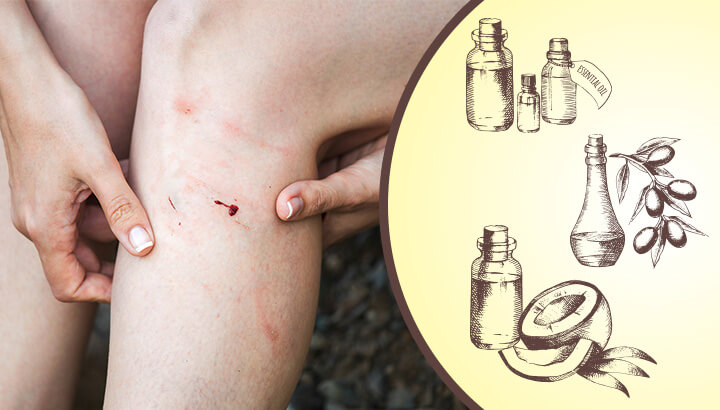 Heal Your Skin Naturally With This DIY Antifungal Cream