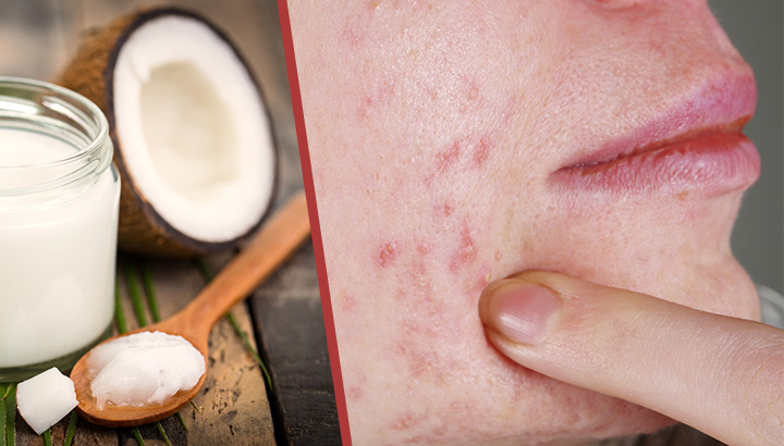 Whip Up This Potent Zit-Zapper Salve For Quick Relief