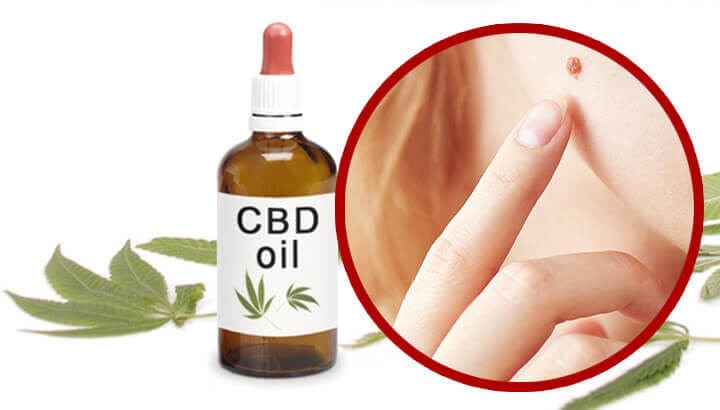 Can CBD Oil Get Rid Of Moles On Your Skin?