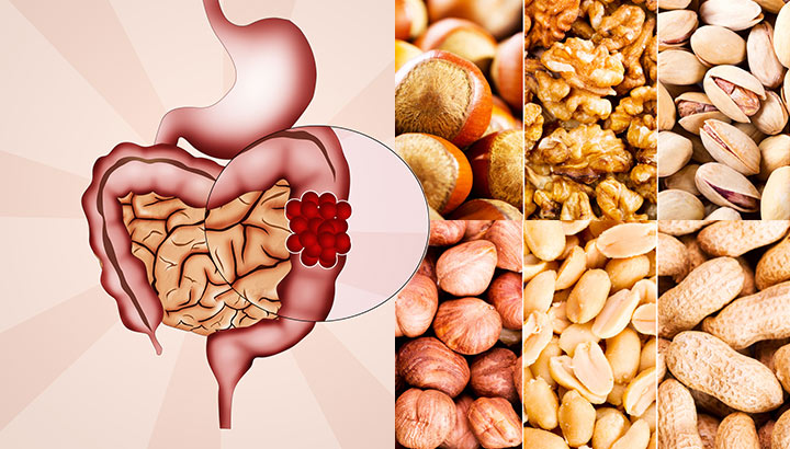 Scientists Say This Food May Help Colon Cancer