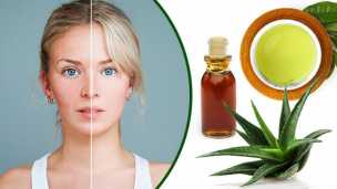 5 Natural Remedies To Treat Rosacea