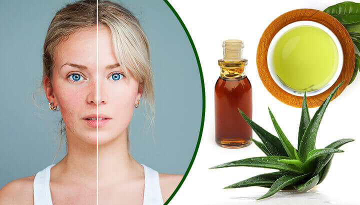 5 Natural Remedies To Treat Rosacea