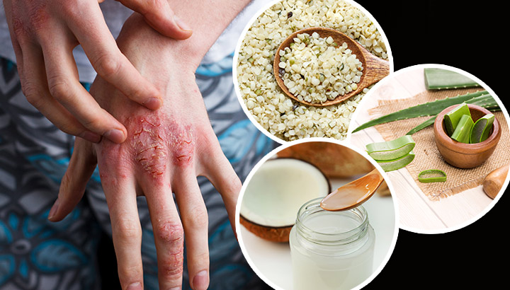 5 All-Natural Remedies To Treat Eczema Without The Doctor