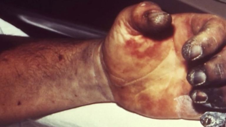 The Plague Is Here, With 124 Dead. Are Americans At Risk?