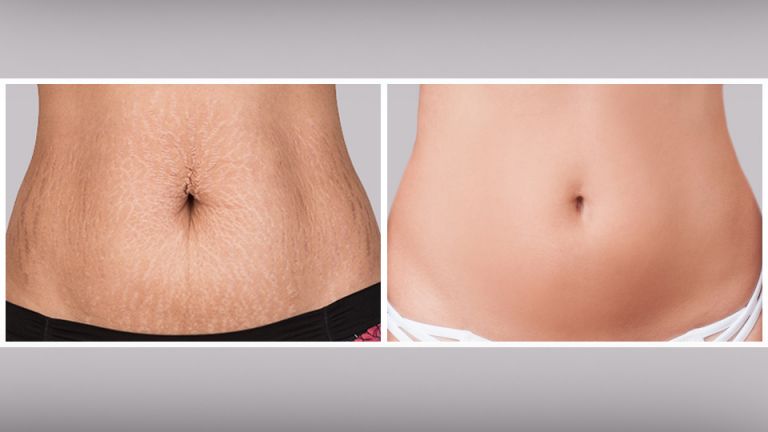 7 Ways To Tighten Flabby Skin After Weight Loss