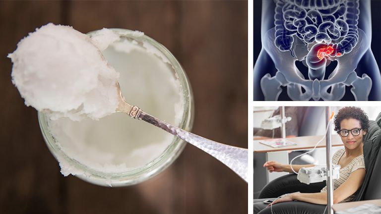 3 Amazing Benefits Of Coconut Oil For Cancer Patients