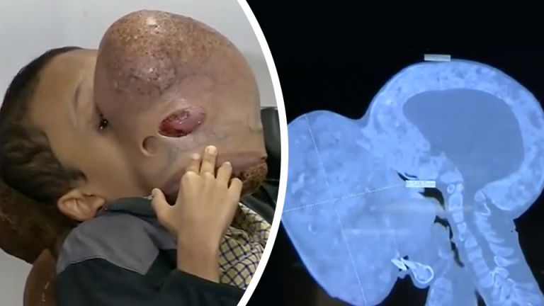 Teenager Dies After 10-Pound Tumor Removed — Should Doctors Have Helped Him Sooner?