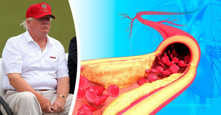 Does Donald Trump Have Heart Disease?