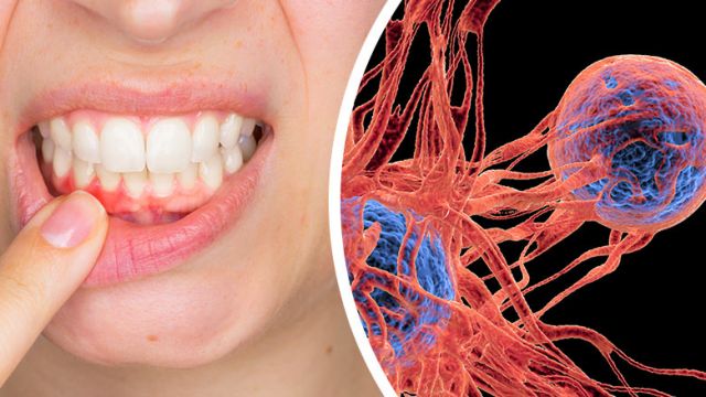 isgumdiseaselinkedtocancer_845x439_39