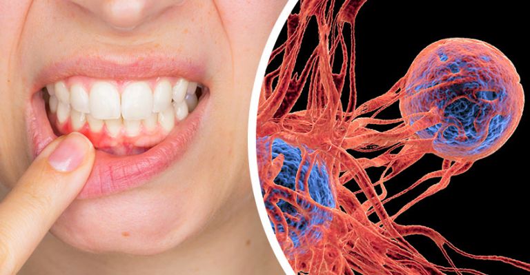 Got Gingivitis? Get Checked For This Deadly Disease