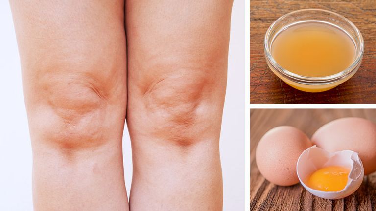 How To Use ACV And Egg Yolks For Knee Pain
