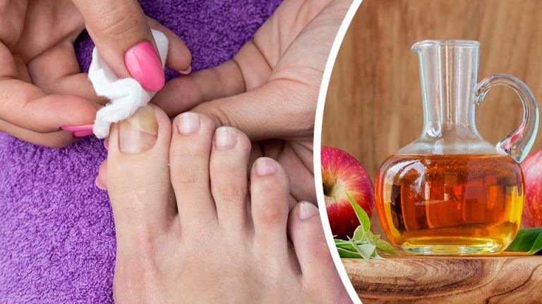 7 Natural Remedies To Banish Toenail Fungus