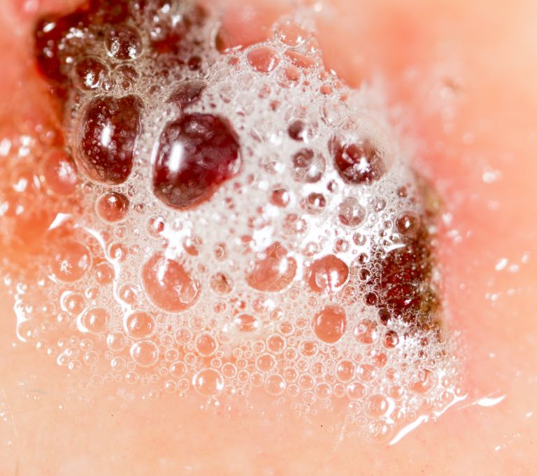 Clean Mold and Wounds with This Must-Have Solution (hint: it’s super cheap)