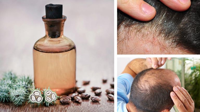Fight Baldness + 2 Other Reasons To Use Castor Oil On Your Hair
