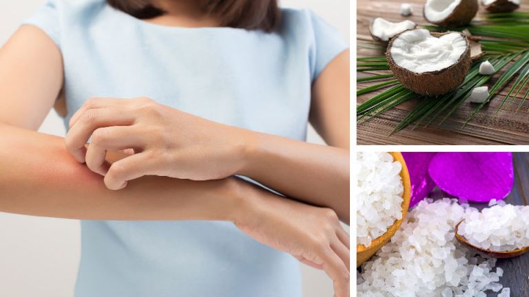 I’ve Suffered From Eczema My Whole Life. Here Are 5 Natural Remedies That Help