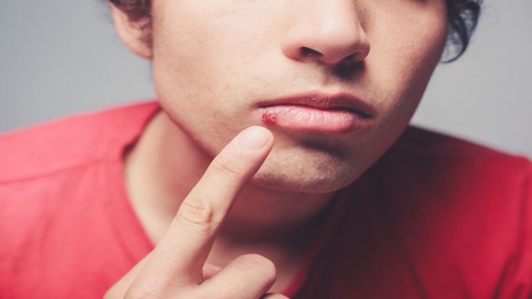 6 Ways to Naturally Banish that Blister on Your Lip