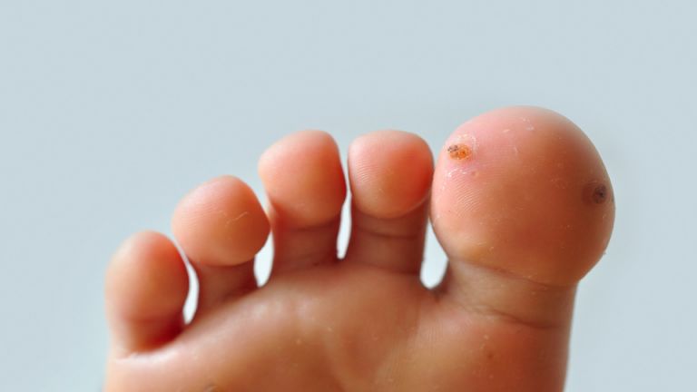 Try These Ways to Get Rid of Warts Fast…Naturally