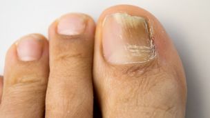 Stop! Don’t Ignore Toenail Fungus or Else