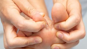 Foot Fungus Fixes You Can Make at Home