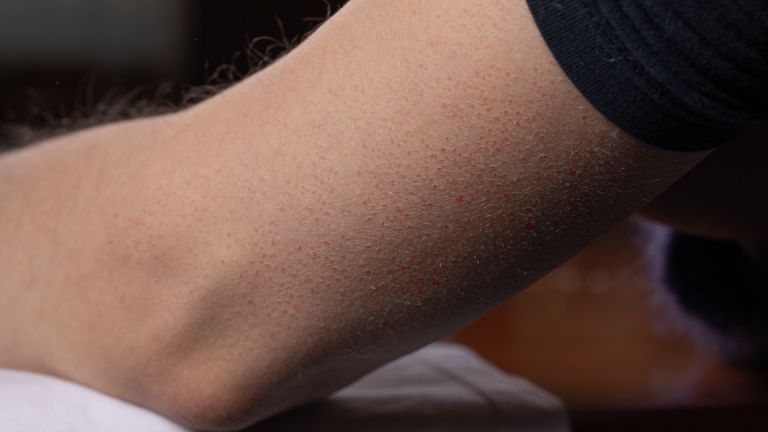 The Solution for the Little Red Bumps on Your Arms