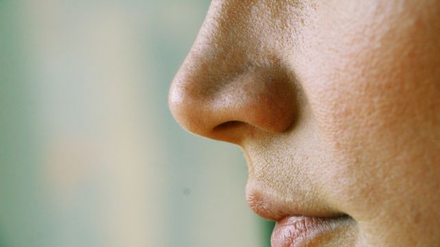 enlarged pores on the girl's face close up