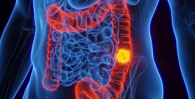 Eating This for Breakfast May Lower Colon Cancer Risk