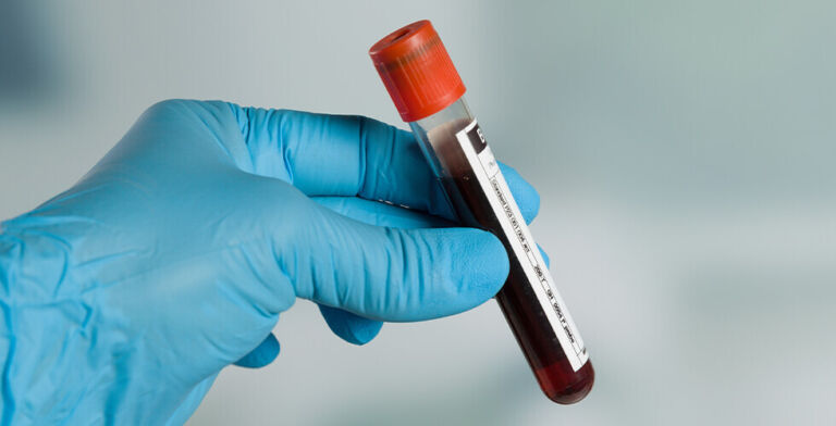 Simple Blood Test Could Revolutionize Alzheimer’s Diagnosis