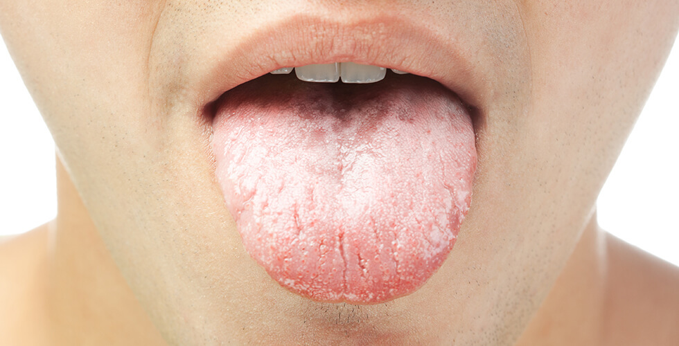 What a White Tongue Says About Your Health (And Why Brushing Won’t Fix It)