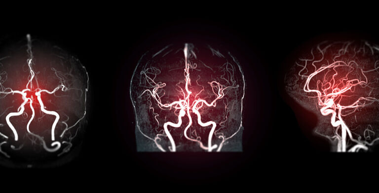 Plastic in Your Arteries? Shocking New Study Links Microplastics to Stroke Risk