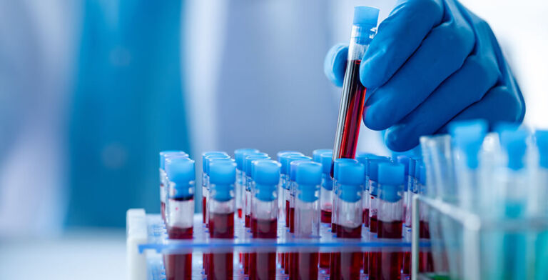 Revolutionary Blood Test Brings Faster, More Accurate Alzheimer’s Diagnosis