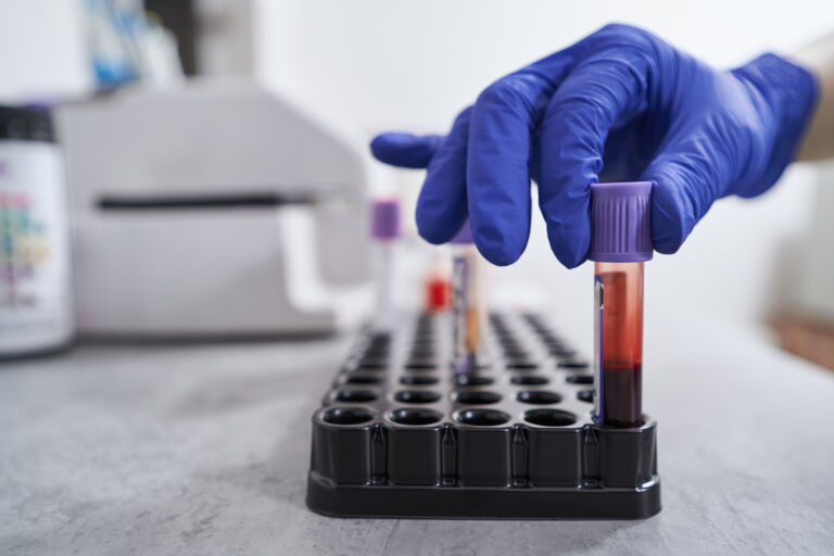 Your Blood Type Might Influence Stroke Risk Before Age 60—Here’s What Scientists Found