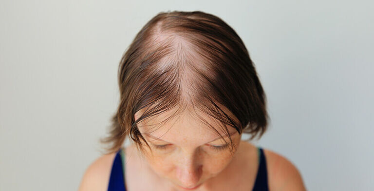 Thinking About Hair Loss Treatments? Here’s the Hidden Risk No One Talks About