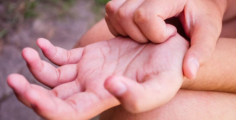 Surprising Reasons Why Your Palms Itch